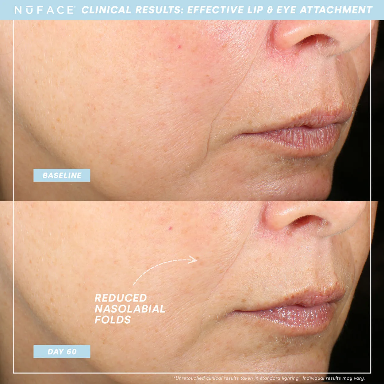 Trinity  and Effective Lip and Eye Attachment