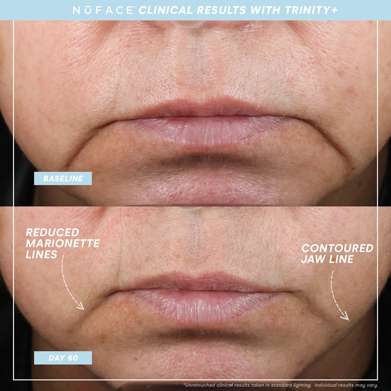 Trinity  and Effective Lip and Eye Attachment